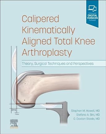Calipered Kinematically Aligned Total Knee Athroplasty